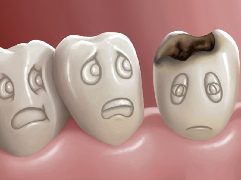 پوسیدگی دندان و علت های آن